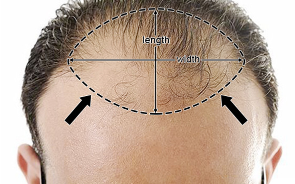 male pattern baldness